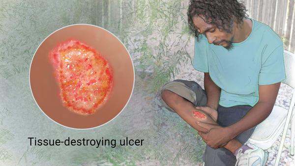 Buruli Ulcer the next pandemic